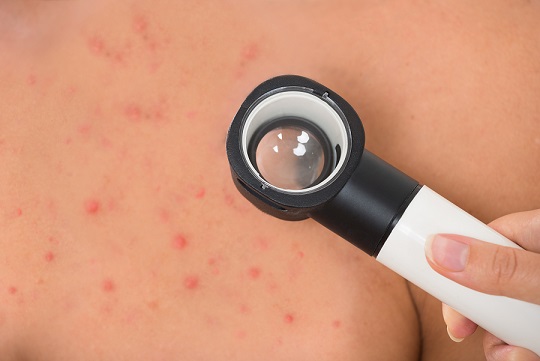 真菌性毛囊炎,油脂养出来的 真菌性毛囊炎,油脂养出来的