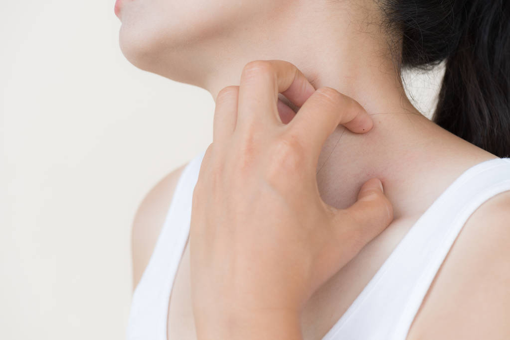 激素药膏,居家护理 激素药膏,居家护理