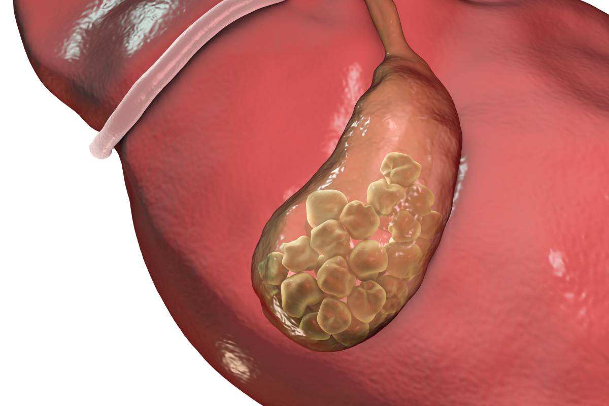 湿热,胆结石,剖面图